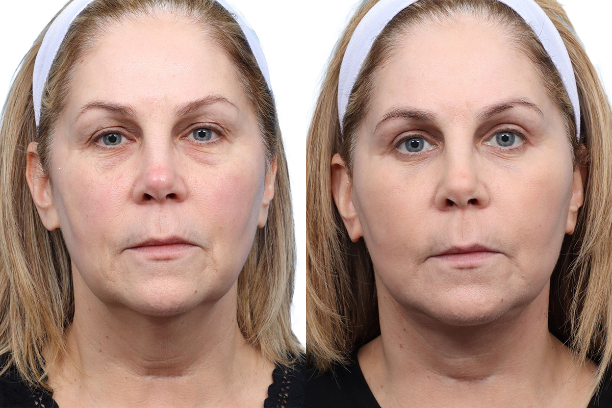 CO2 Laser Before & After Gallery - Patient 171671 - Image 1