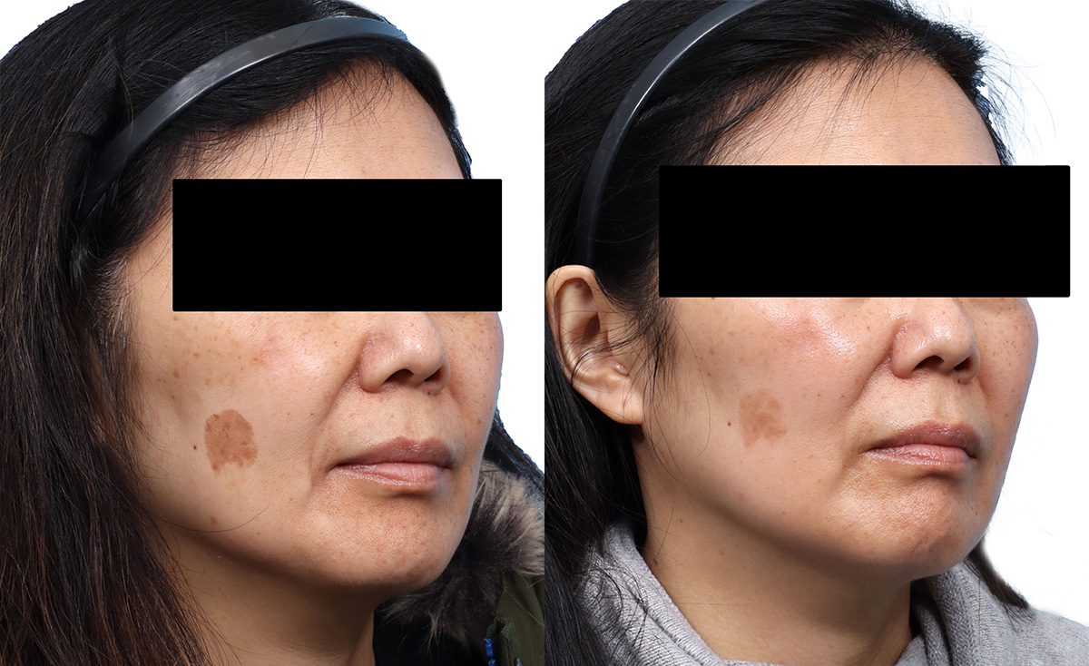 Chemical Peels Before & After Gallery - Patient 426041 - Image 2