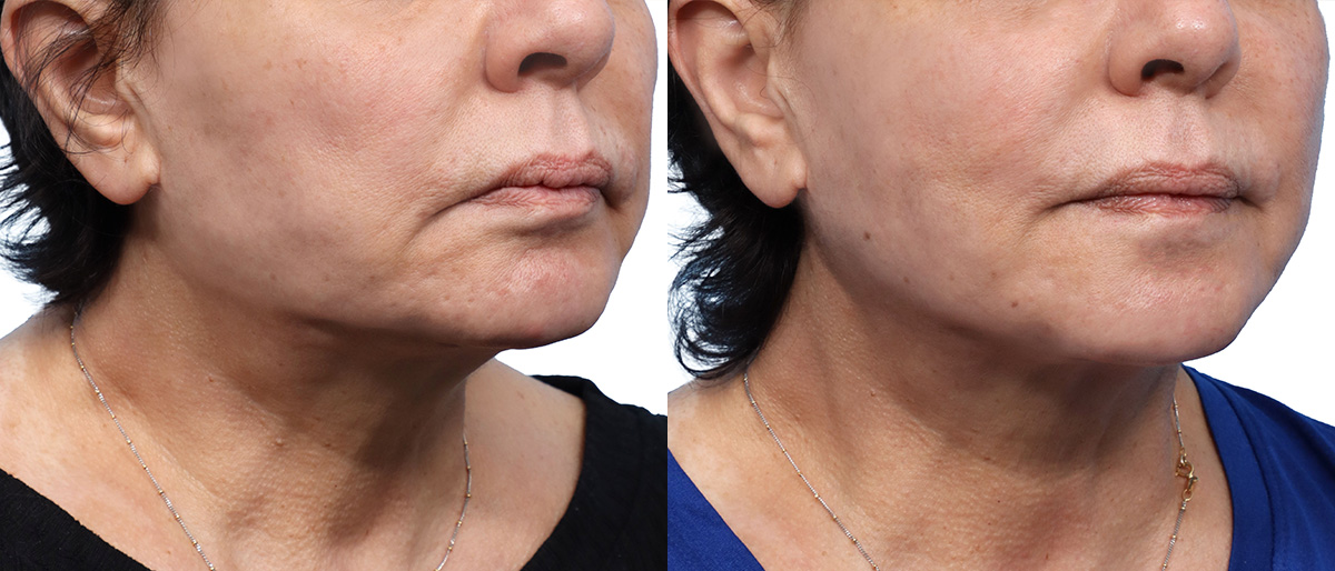 QuantumRF Before & After Gallery - Patient 417241 - Image 1