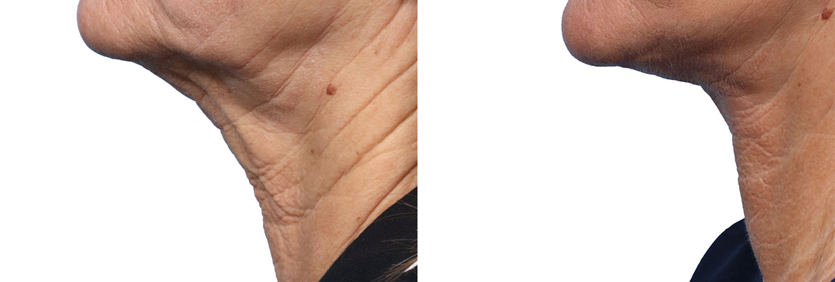 CO2 Laser Before & After Gallery - Patient 231200 - Image 3