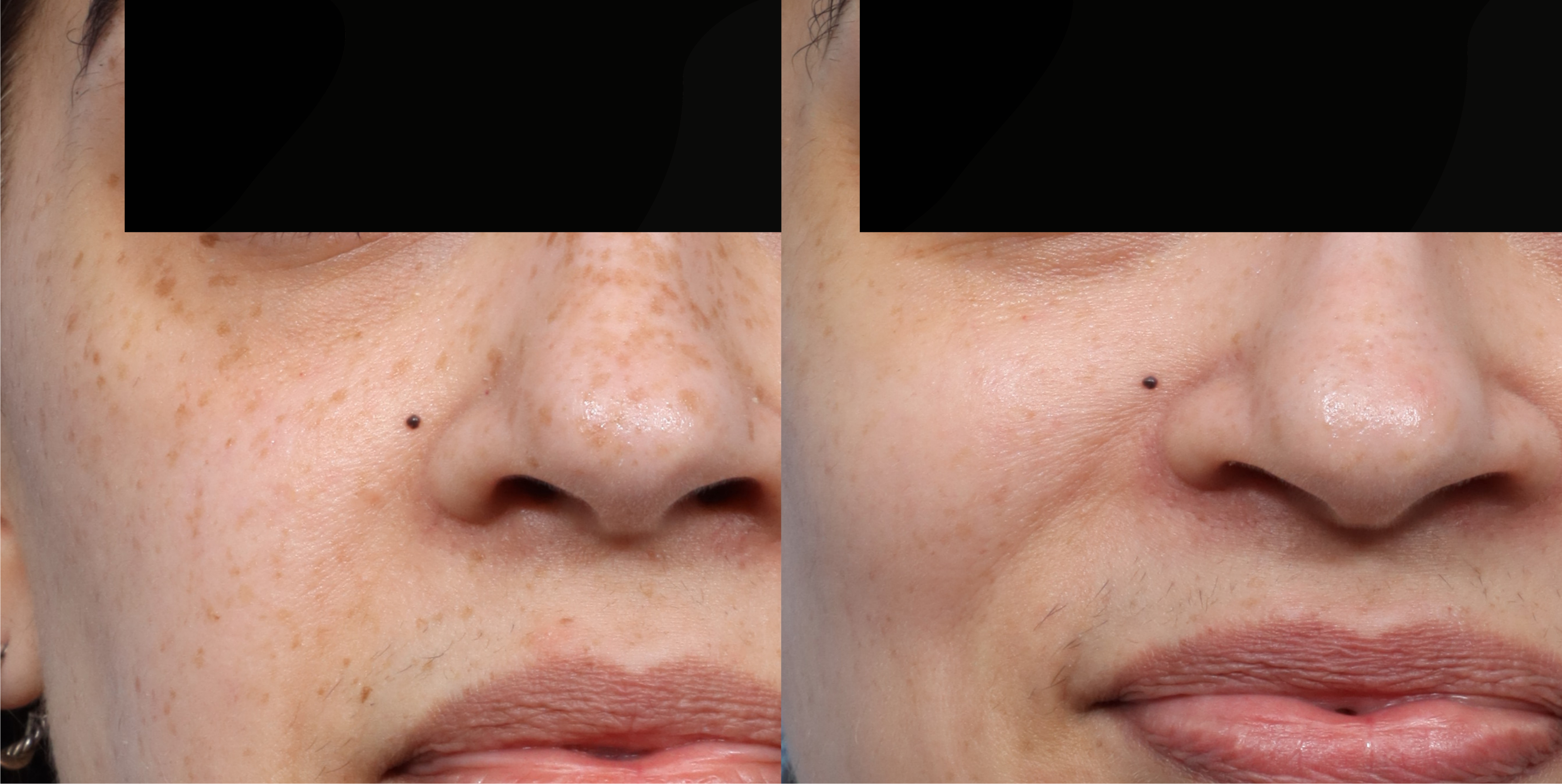 Picoway® Before & After Gallery - Patient 173751 - Image 1