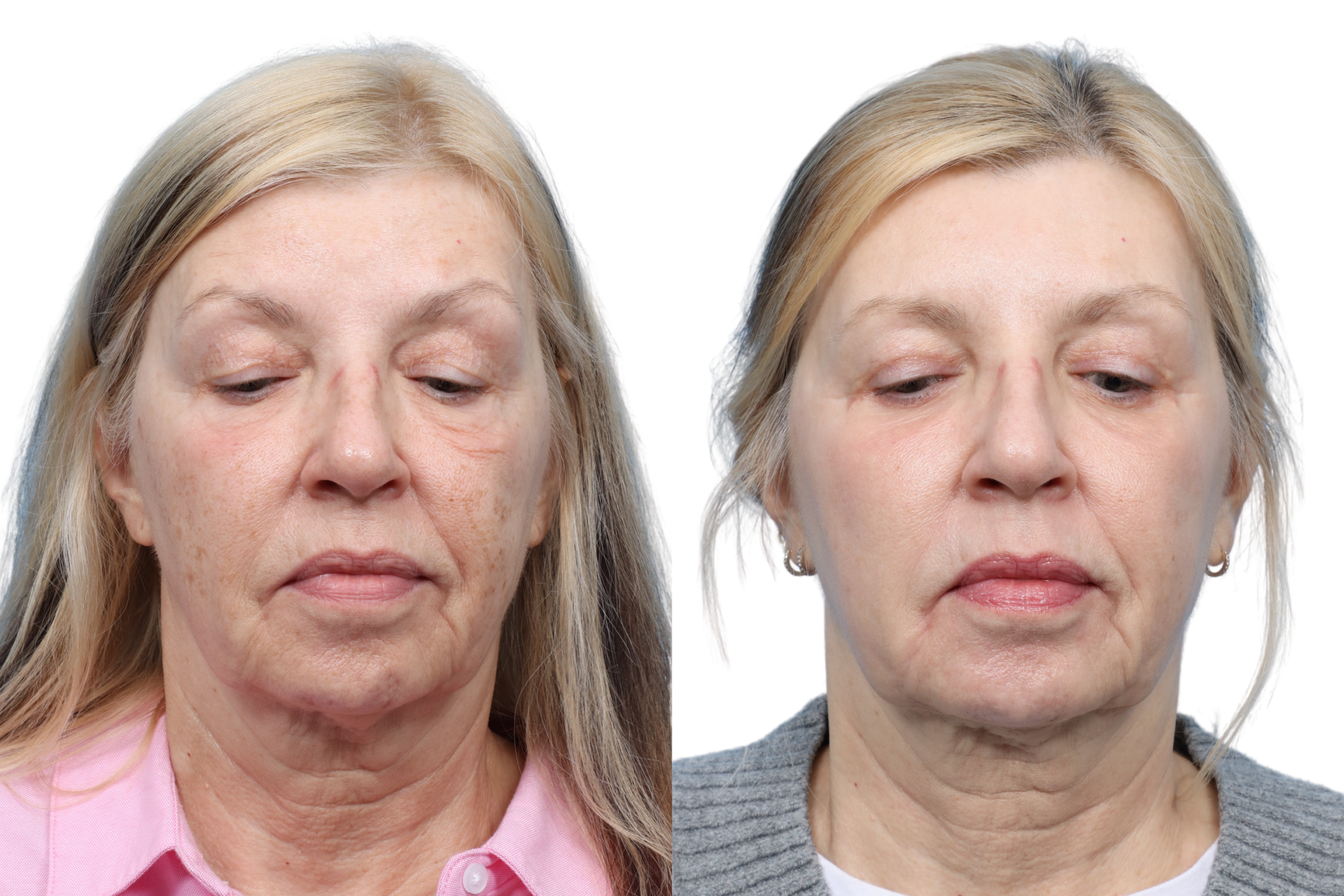 CO2 Laser Before & After Gallery - Patient 185311 - Image 1